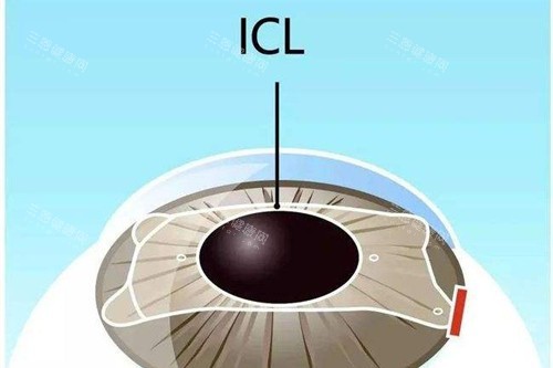 近视眼手术宣传