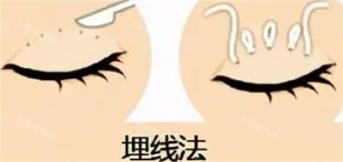 双眼皮埋线怎么做的