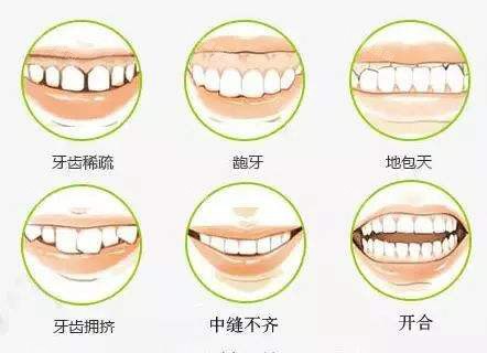 牙齿矫正不同的适应症 牙齿矫正不同的适应症