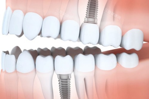 种植牙植入口腔图解 种植牙植入口腔图解