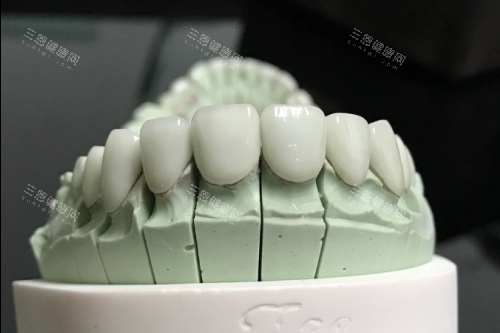 全瓷牙模型展示图 全瓷牙模型展示图