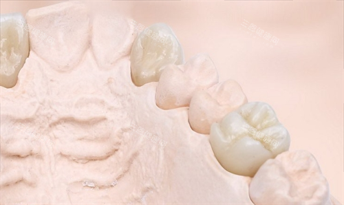 则武全瓷牙模型展示 则武全瓷牙模型展示