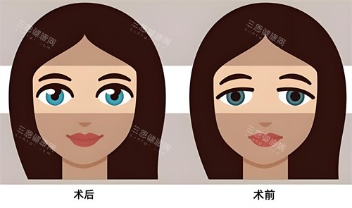 双眼皮术后术前对比动画图