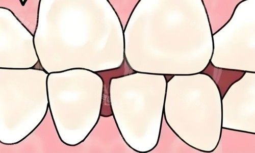 儿牙牙缝宽大 儿牙牙缝宽大