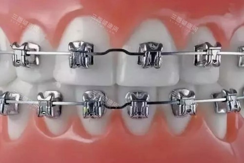 金属矫正卡通模型图 金属矫正卡通模型图