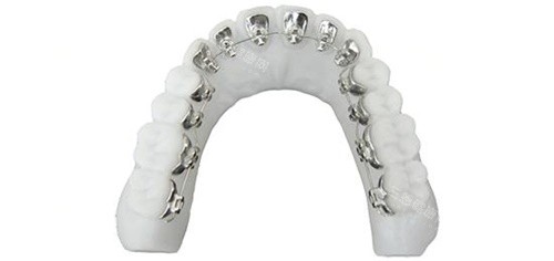 舌侧矫正图片 舌侧矫正图片