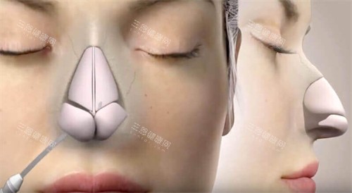 隆鼻手术动画图