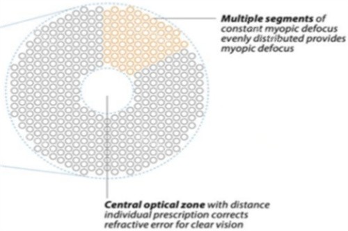 离焦镜片原理图示 离焦镜片原理图示