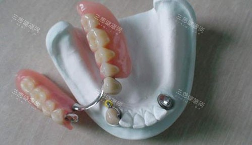 活动假牙半口展示 活动假牙半口展示