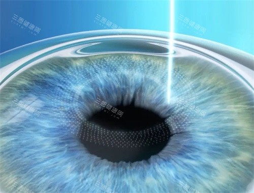全激光近视手术 全激光近视手术