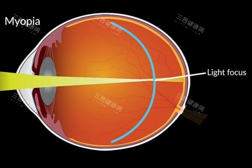 近视成像落在视网膜前