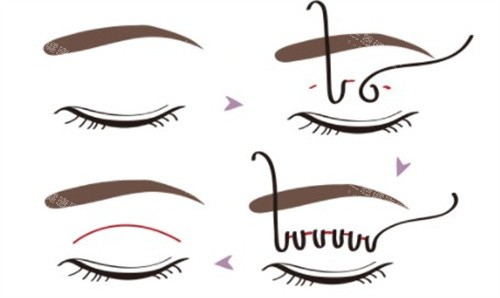 VLINE双眼皮手术 VLINE双眼皮手术