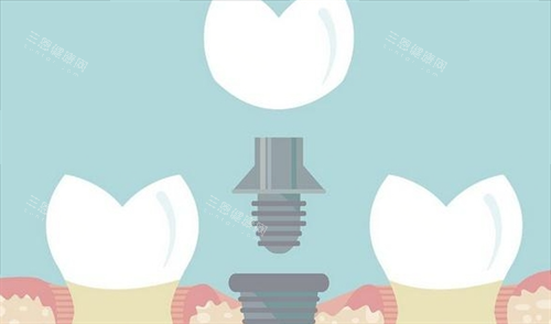 组成种植牙的三部分动画展示