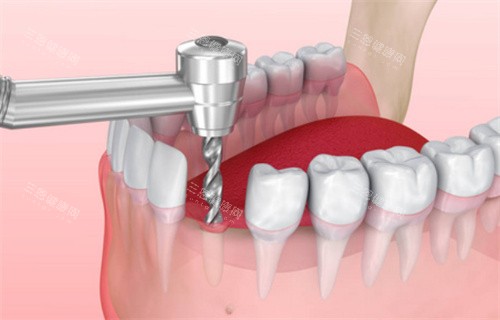 种植牙过程动画展示 种植牙过程动画展示