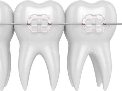 牙齿矫正陶瓷托槽漫画图 牙齿矫正陶瓷托槽漫画图