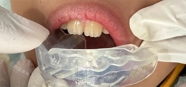 罗慕牙齿矫正 罗慕牙齿矫正