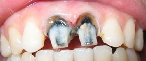 烤瓷牙前牙齿的情况 烤瓷牙前牙齿的情况