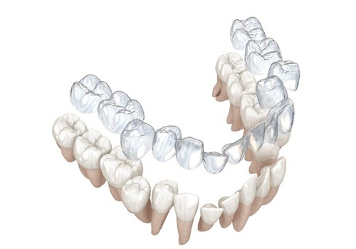 隐形矫正牙齿过程 隐形矫正牙齿过程