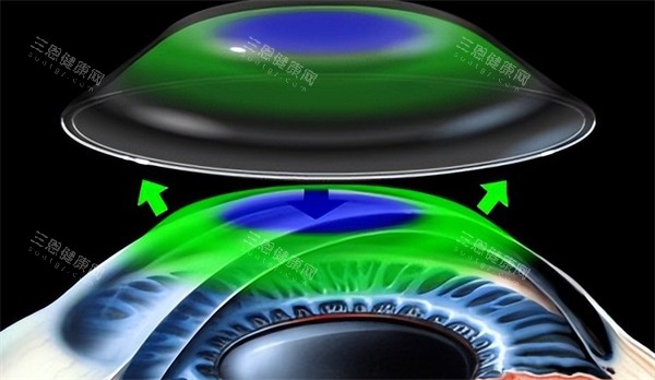 离焦软镜佩戴过程图解