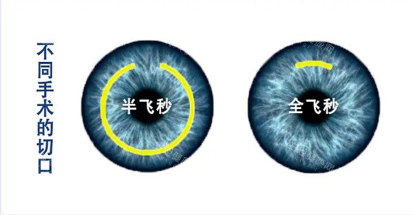 半飞秒和全飞秒区别