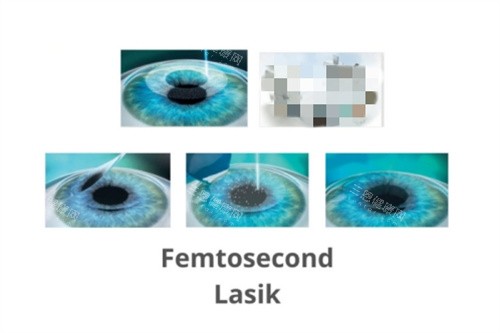 杭州陈小平医生是时光医院磨骨特色医生！定制化设计显轮廓，术后自然不夸张