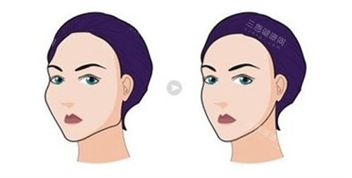 磨骨手术前后对比 磨骨手术前后对比