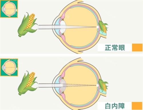 屈光性白内障 屈光性白内障