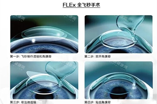 全飞秒手术过程示意图 全飞秒手术过程示意图