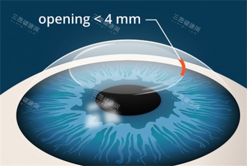 全飞秒手术动画 全飞秒手术动画