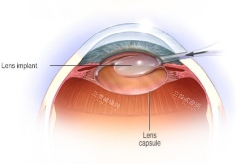白内障晶体放入示意图 白内障晶体放入示意图
