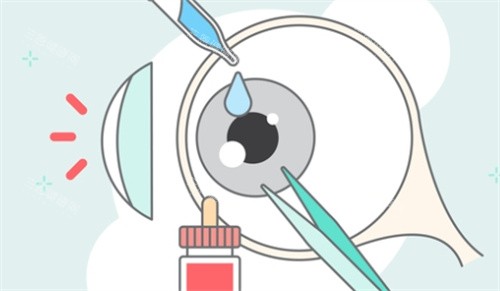 角膜炎治疗 角膜炎治疗