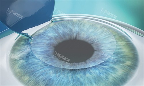 近视手术制瓣中 近视手术制瓣中