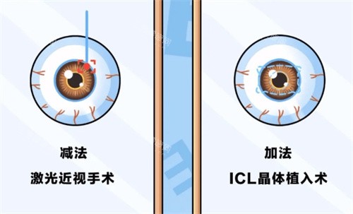 近视手术的分类