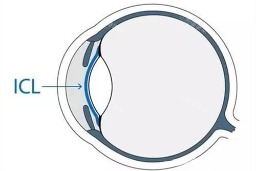 ICL晶体植入近视眼手术眼球位置示意图