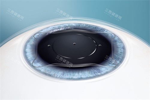 徐州做近视眼手术大概多少钱？激光类7000元起 晶体类26500元起！