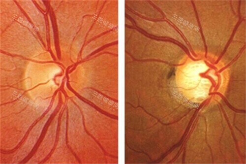 青光眼眼球示意图