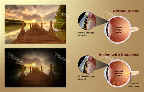 青光眼动画图示