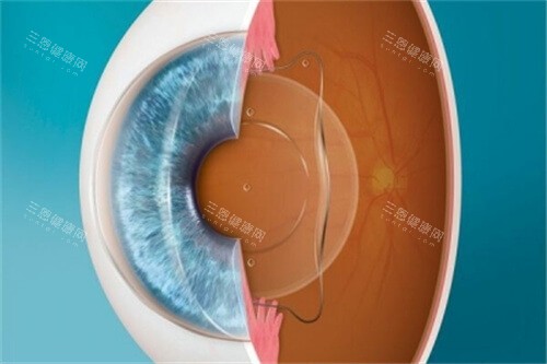 麦迪格眼科医院近视手术价格一览表！全新价目表参考，看这篇就够！