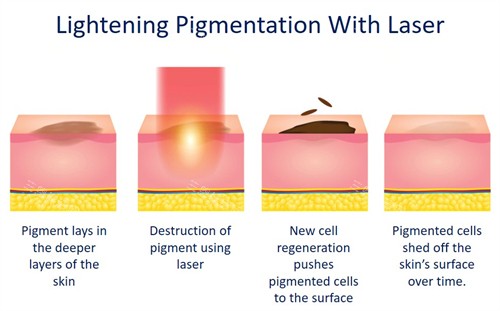 激光祛斑如何改善皮肤斑点 激光祛斑如何改善皮肤斑点