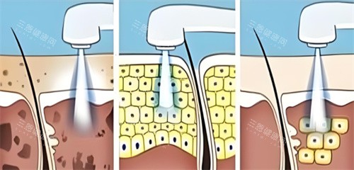 皮秒祛斑 皮秒祛斑