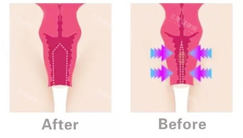 阴道紧缩对比图 阴道紧缩对比图