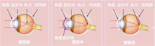 角膜塑形原理 角膜塑形原理