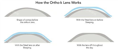 角膜塑形镜改善眼表 角膜塑形镜改善眼表