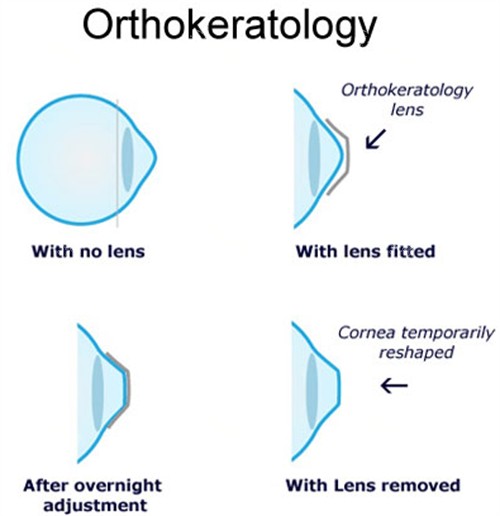 角膜塑形镜佩戴前后对比 角膜塑形镜佩戴前后对比
