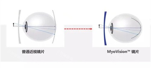 蔡司成长乐镜片原理 蔡司成长乐镜片原理