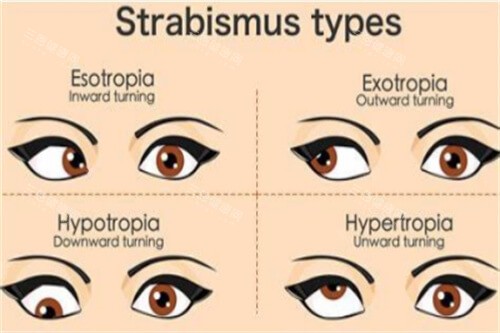 不同斜视对比图 不同斜视对比图