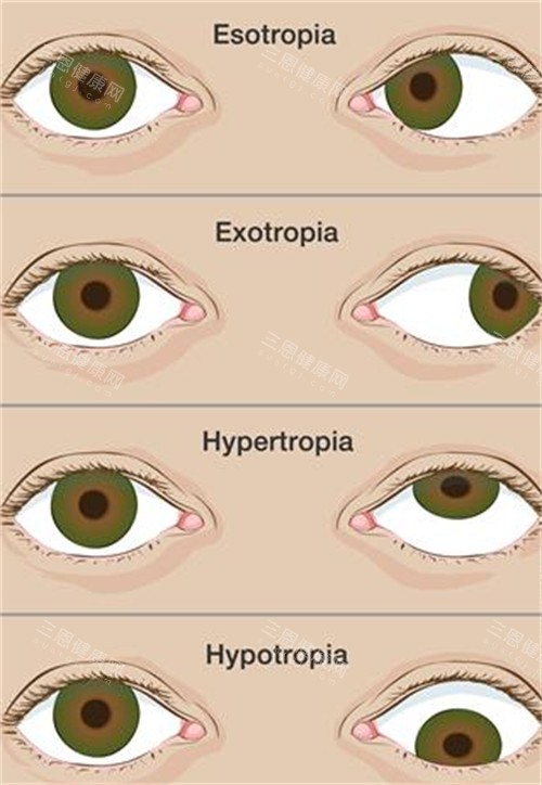不同程度的斜视眼睛 不同程度的斜视眼睛