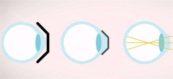 近视矫正过程中眼球的变化图解 近视矫正过程中眼球的变化图解