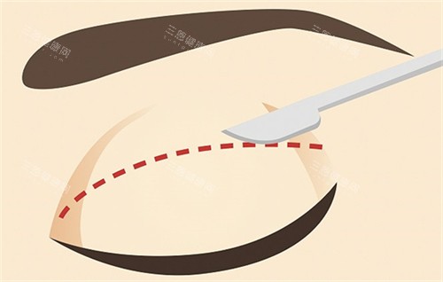 双眼皮的切口切线