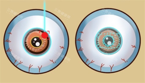 近视手术不同种类的眼球表现 近视手术不同种类的眼球表现
